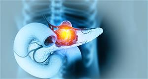 Oncosil device successfully treats pancreatic cancer in Türkiye