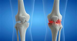 FDA hands Paradigm Biopharma guidance to re-jig phase 3 osteo trial – or is it a delay?