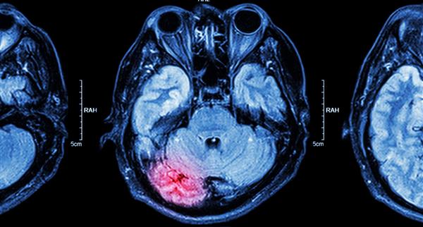 MRI of brain injury