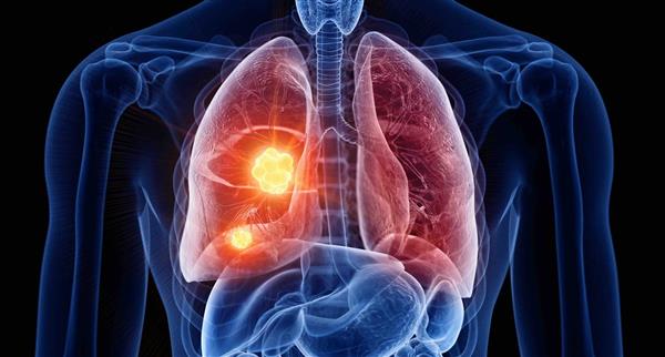 Lung cancer
